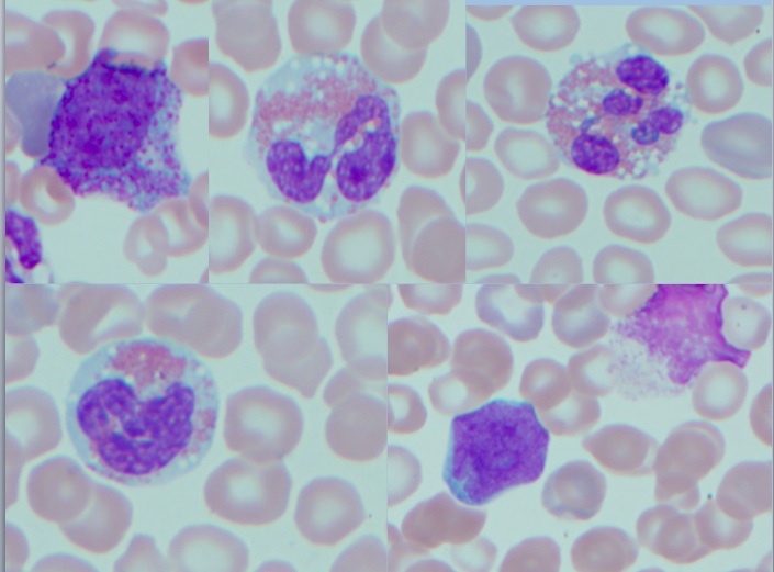 Peripheral blood smear shows leukocytosis with absolute neutrophilia and absolute eosinophilia.  The granulocytes are left shifted, including rare blasts, and show reactive changes, including toxic granulation and vacuolization.  The eosinophils show reactive or atypical features, including hyperlobation, polarization of granules, degranulation, and cytoplasmic vacuolization